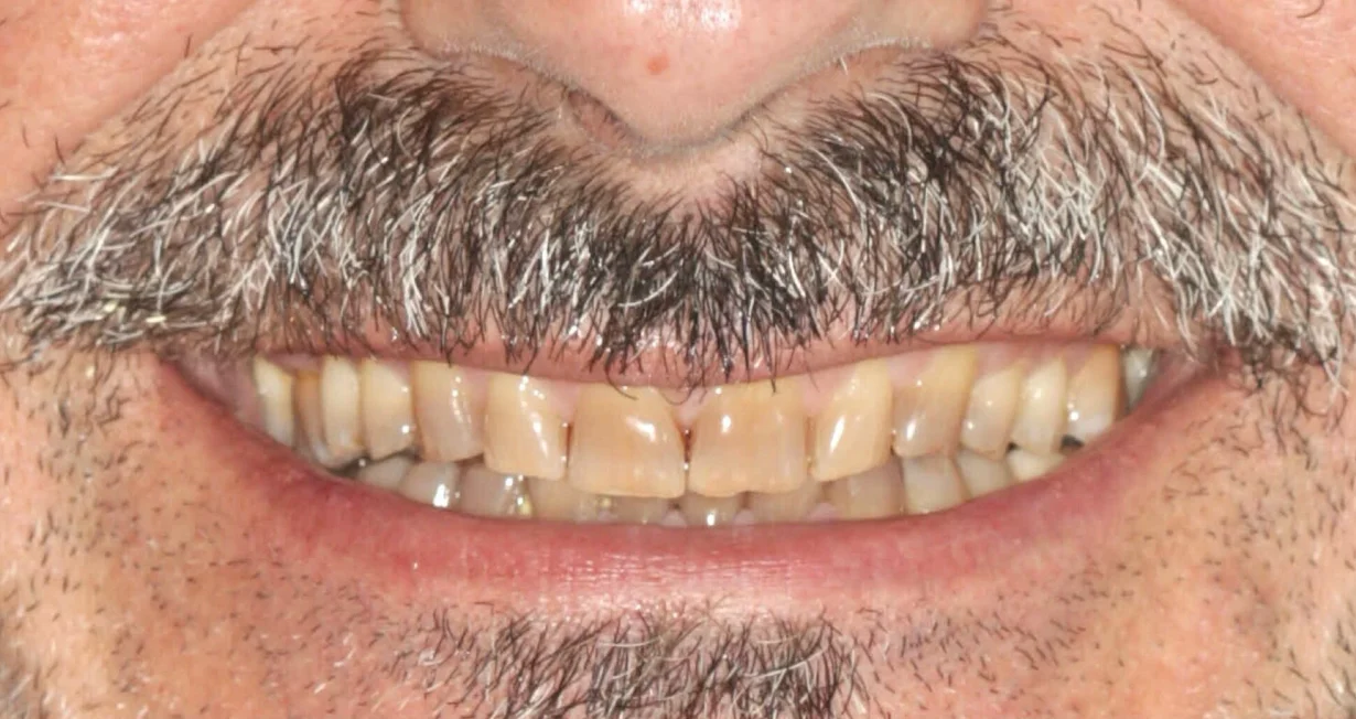 Comprendere e Proteggere i Denti dall'Usura 1 Denti